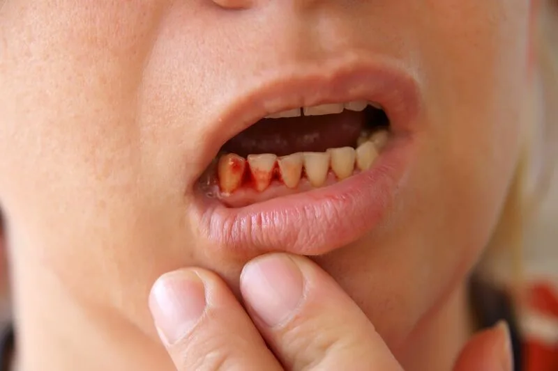 chay mau chan rang do dau